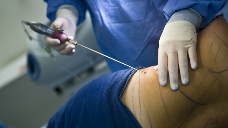 Person undergoing liposuction