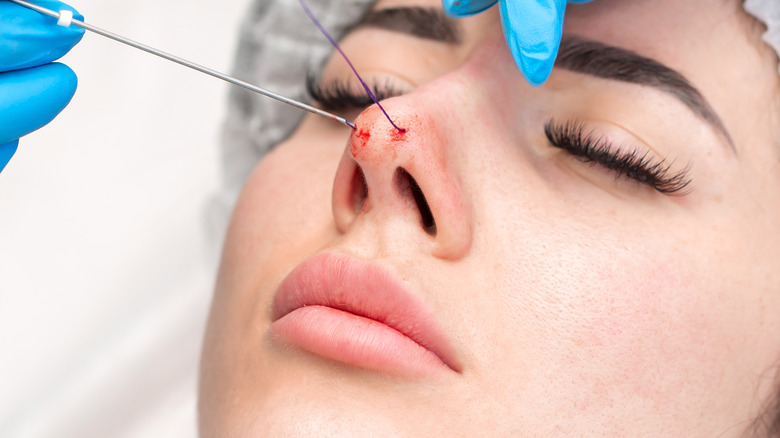 female thread lift procedure