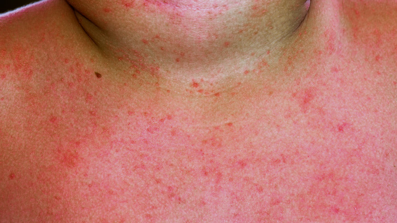 Inflamed heat rash on neck