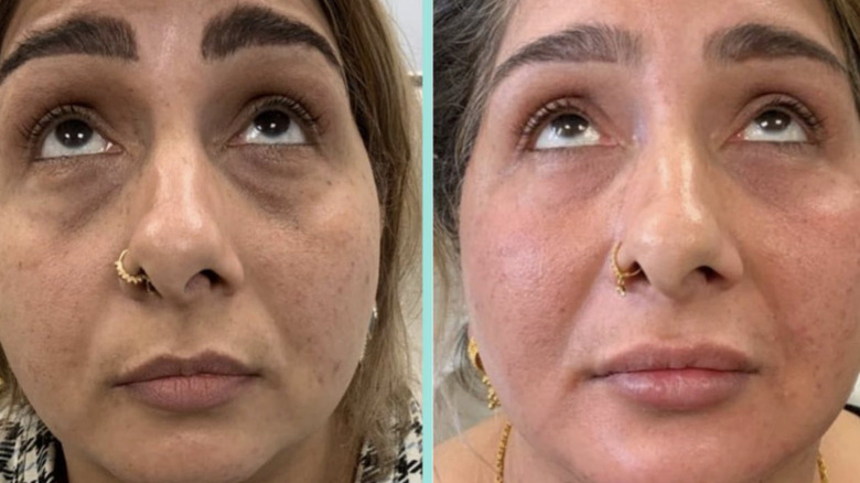 Comparison of woman before and after under-eye fillers