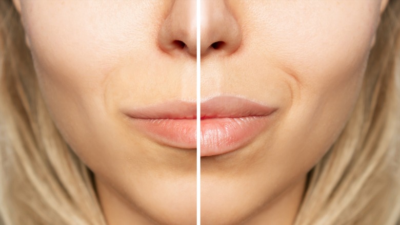 Before and after of lip filler 