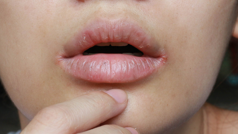 woman with lip dermatitis