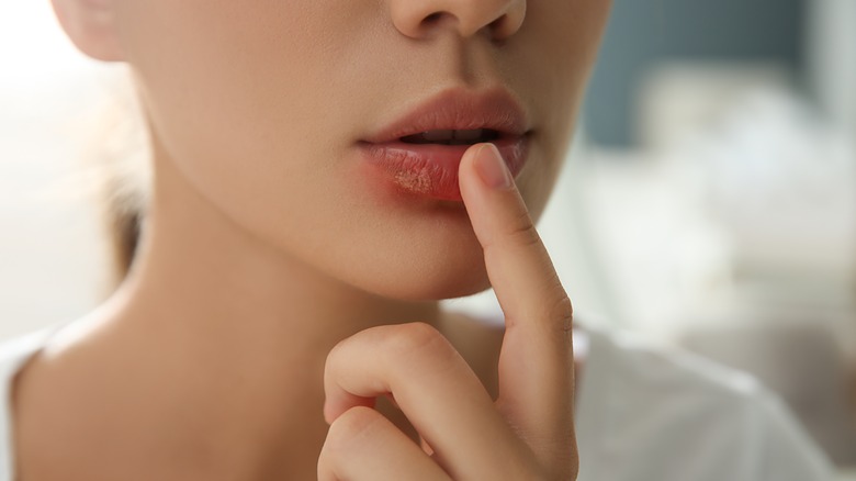 Woman touching her sore lips