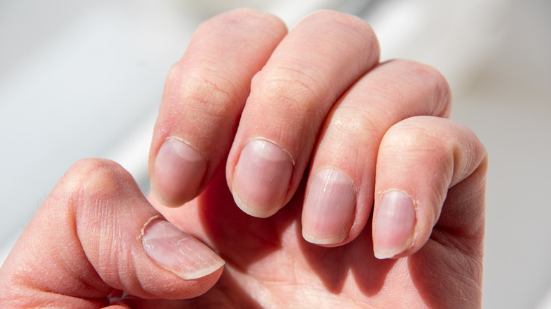 Hand with dry cuticles