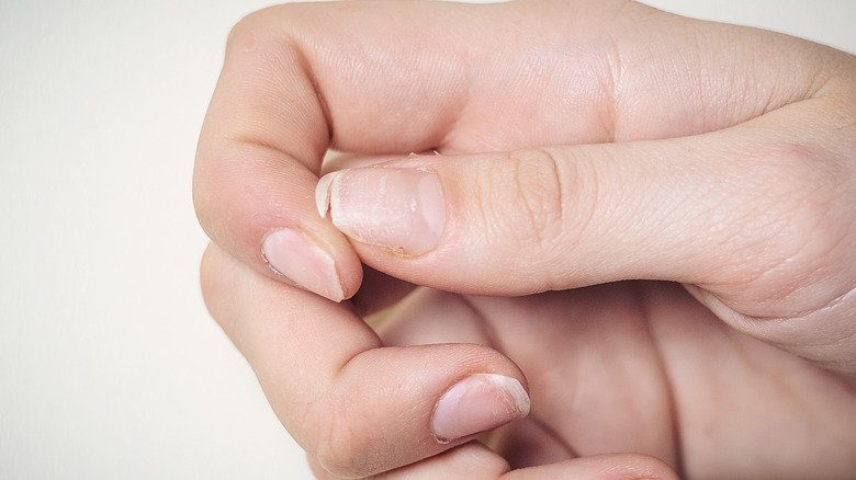 Hand with brittle nails