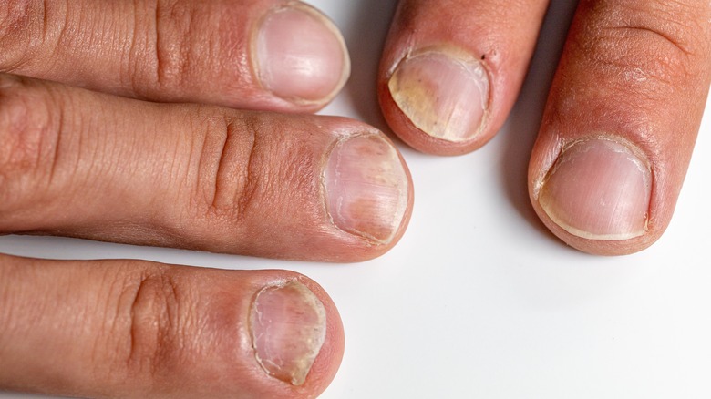 Disformed fingernails 