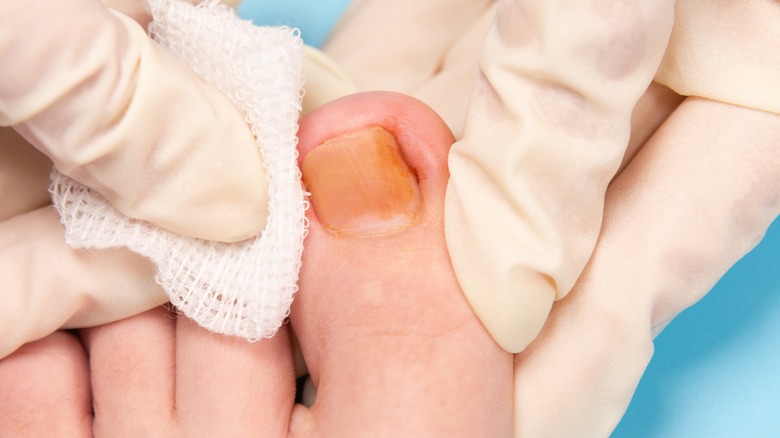 Doctor holding patient's ingrown toenail