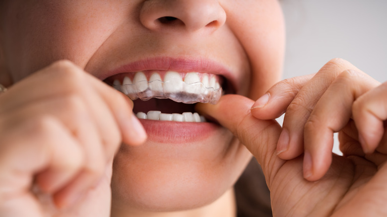 Woman putting in a dental night guard