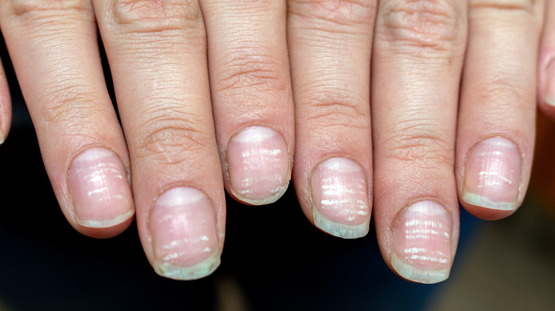 nails of person with anemia 