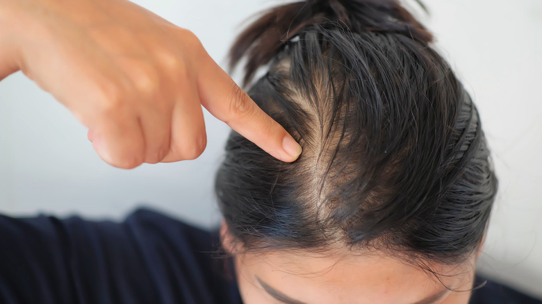 Woman points at her thinning hair