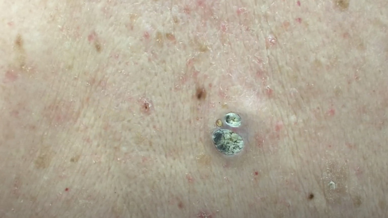 dilated pore of Winer close-up