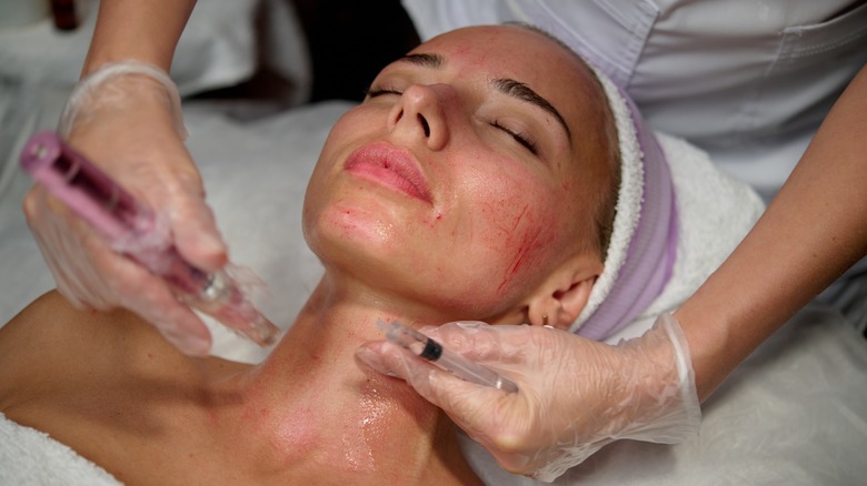 microneedling procedure