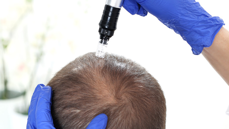microneedling on man's scalp