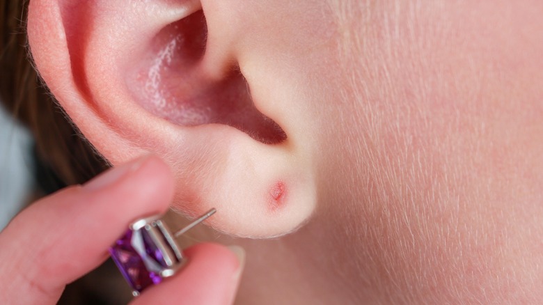 infected ear piercing