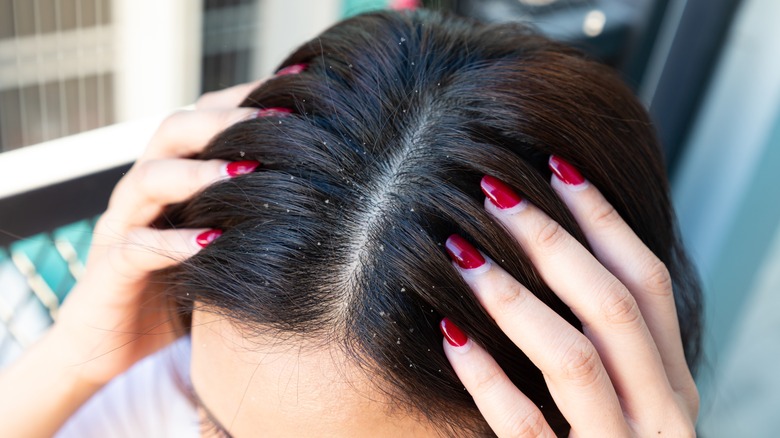 woman with dandruff