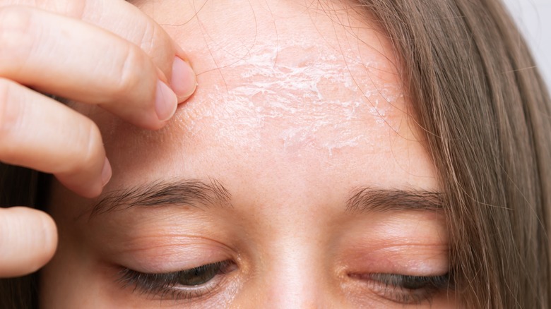 Why The Skin On Your Forehead May Be Flaking