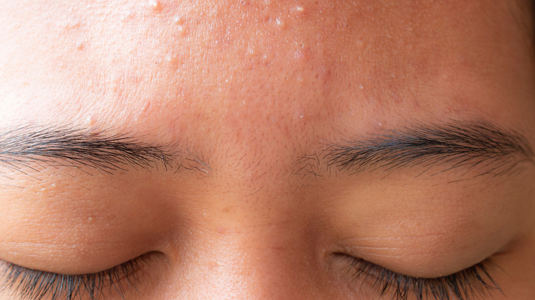 flaky forehead with acne