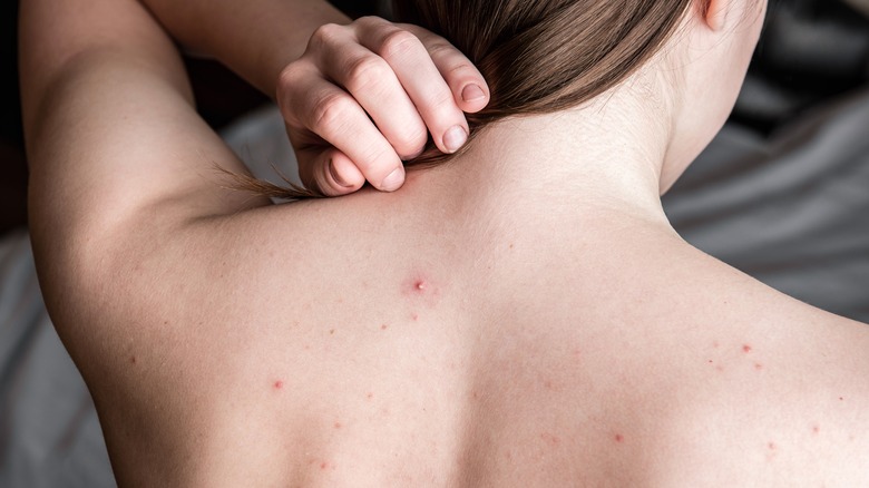 Woman with minor back acne