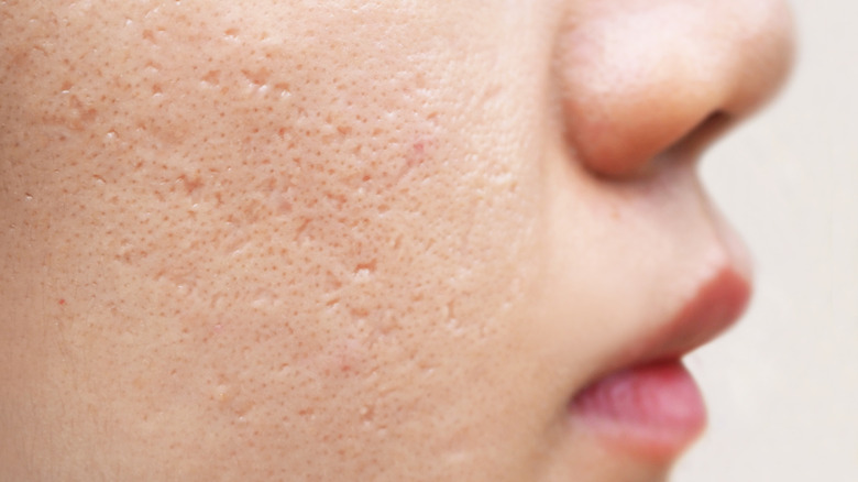 Acne scars on skin