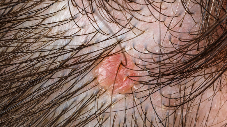 close up of growth on scalp