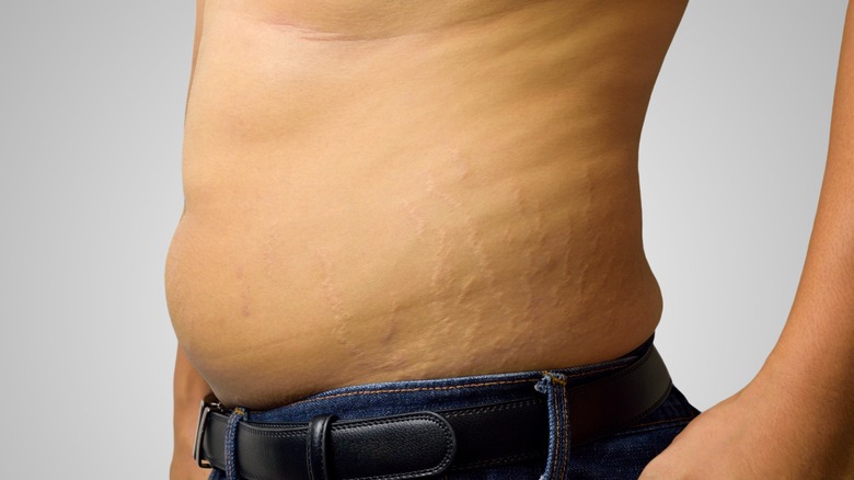 man with stretch marks