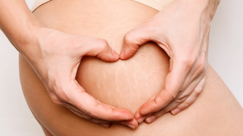 stretch mark love