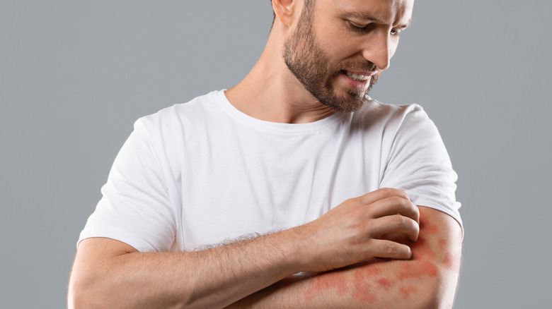 man scratching red patches on arm