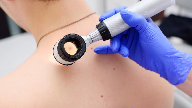 gloved doctor examining back of patient with freckles