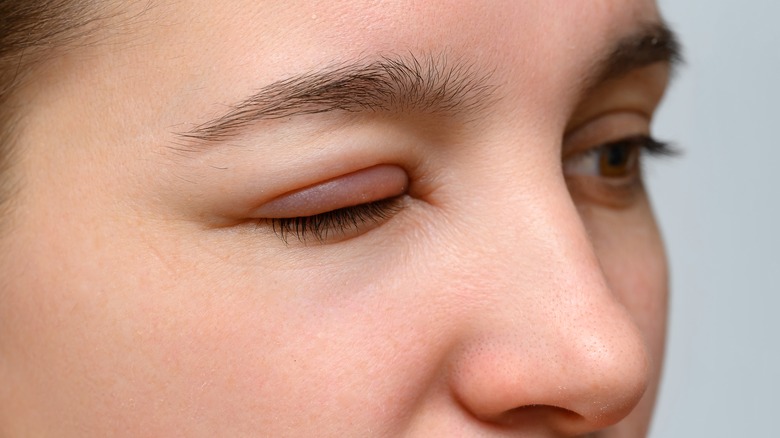 woman with swollen eye