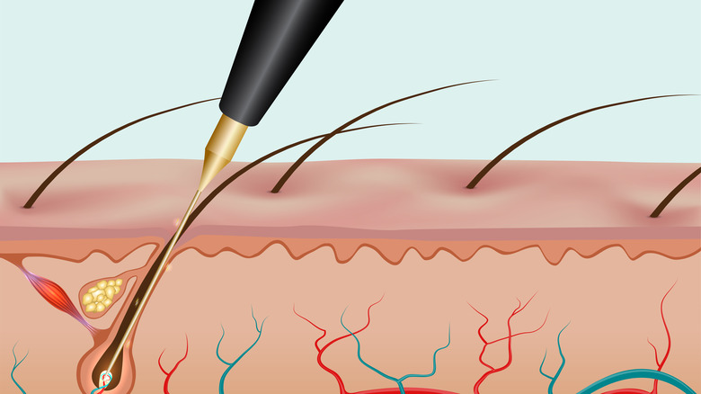 illustration of probe in follicle