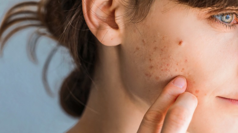 acne on a woman's face