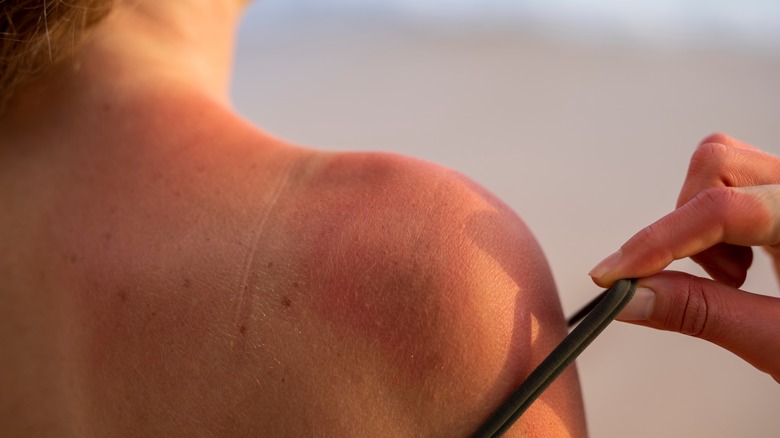 woman with sunburned skin