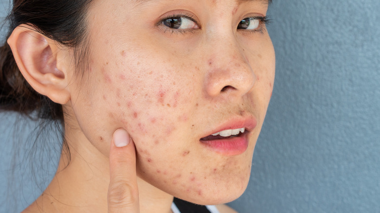 before and after acne scarring