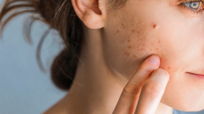 woman with acne scars