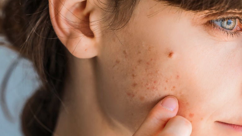 woman with facial acne