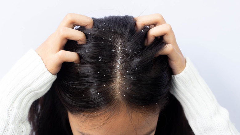 Woman with dandruff on scalp