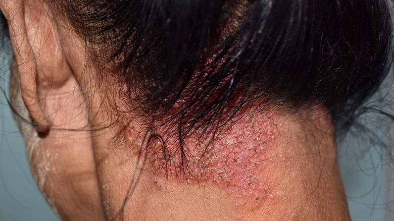 Seborrheic dermatitis example